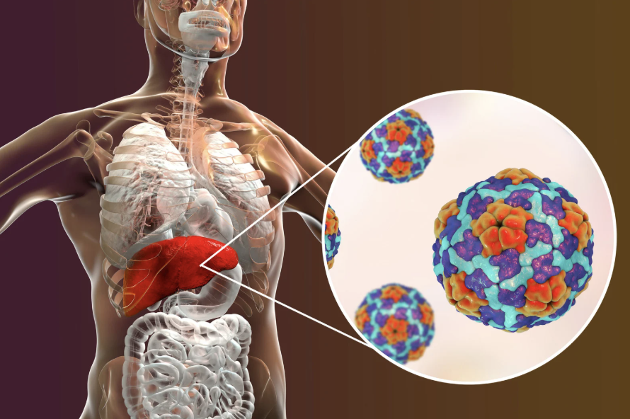 Lee más sobre el artículo HEPATITIS VIRALES: MÁS COMUNES DE LO QUE CREES