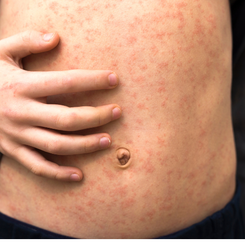Lee más sobre el artículo SARAMPIÓN: UNA ENFERMEDAD INFECCIOSA ALTAMENTE CONTAGIOSA