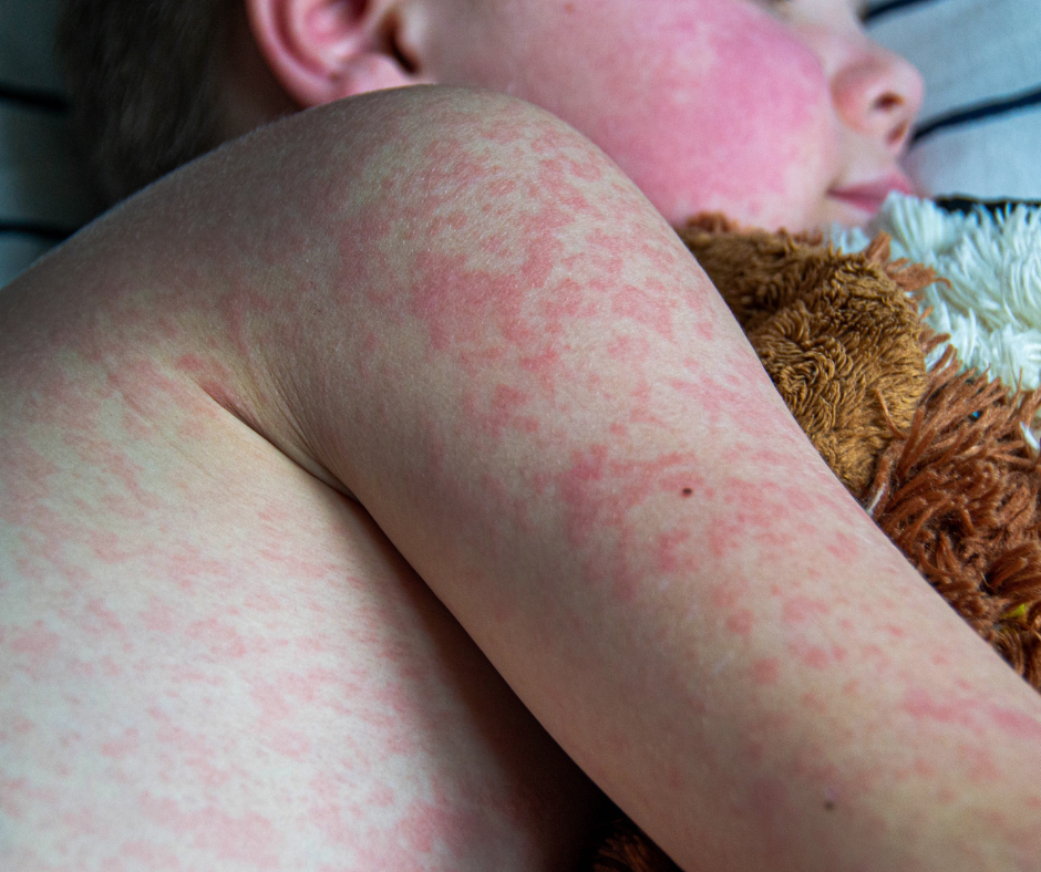 Lee más sobre el artículo Sarampión: la vacuna salva vidas