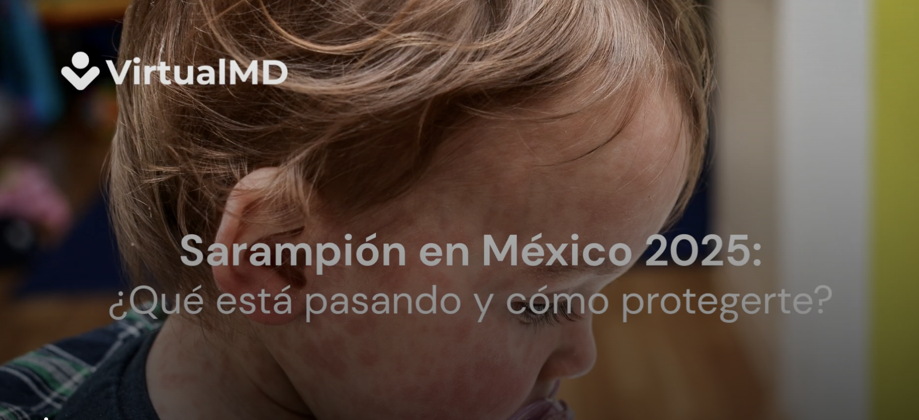 Lee más sobre el artículo Sarampión en México 2025