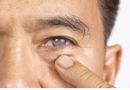 Lee más sobre el artículo ¿Qué son las cataratas?