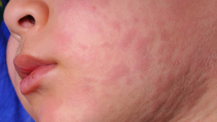 Sarampión: qué es, por qué está reapareciendo en México y cómo protegerte