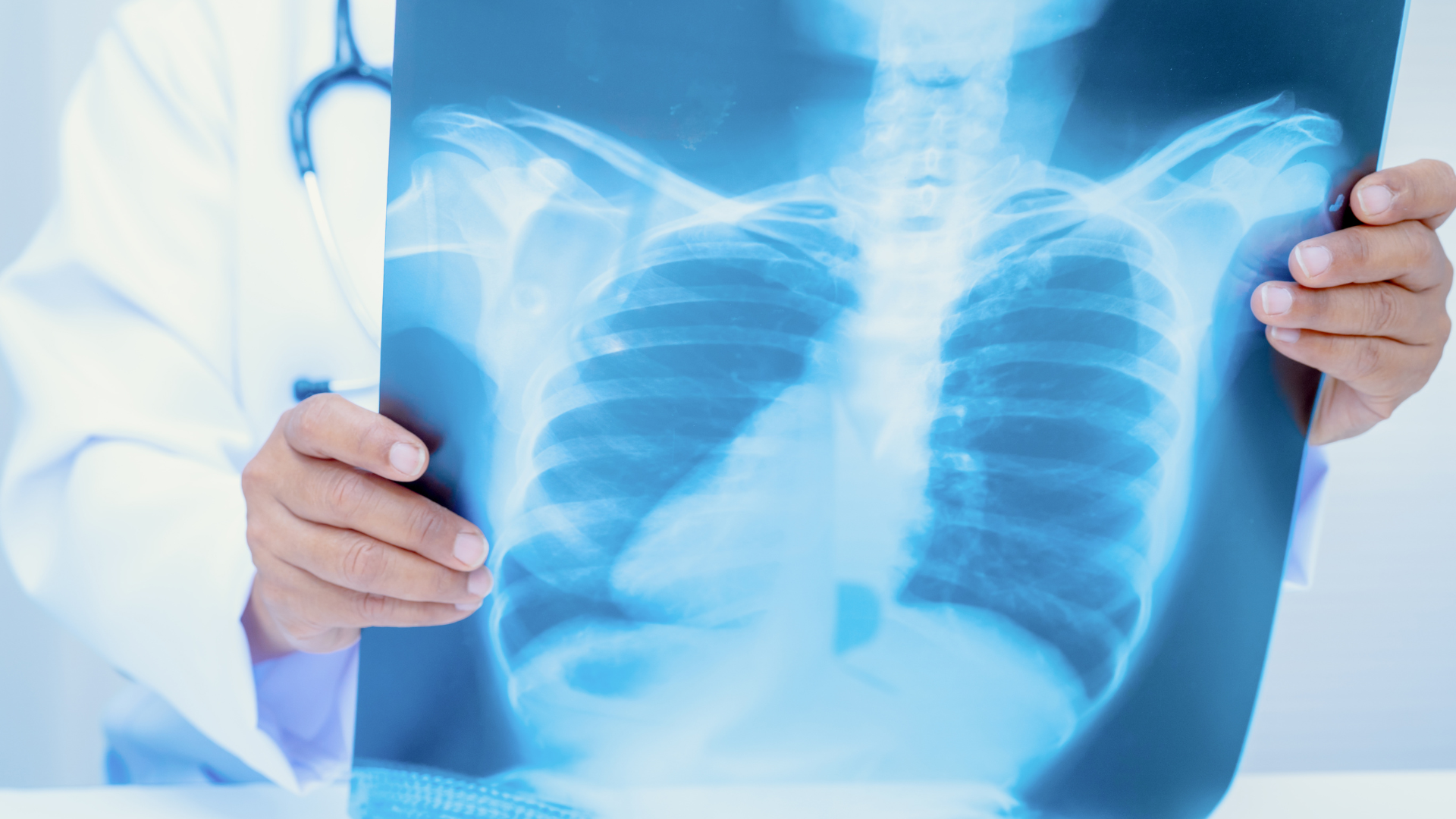 Lee más sobre el artículo Tuberculosis: situación actual, transmisión, diagnóstico y tratamiento basado en evidencia científica